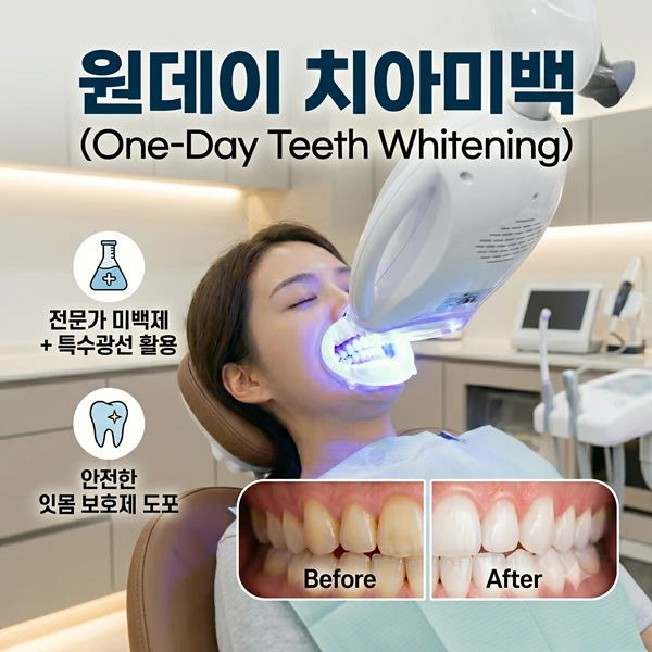 단 하루 만에 완성하는 환한 미소, 원데이미백 필수 확인 가이드 | 365효플란트치과